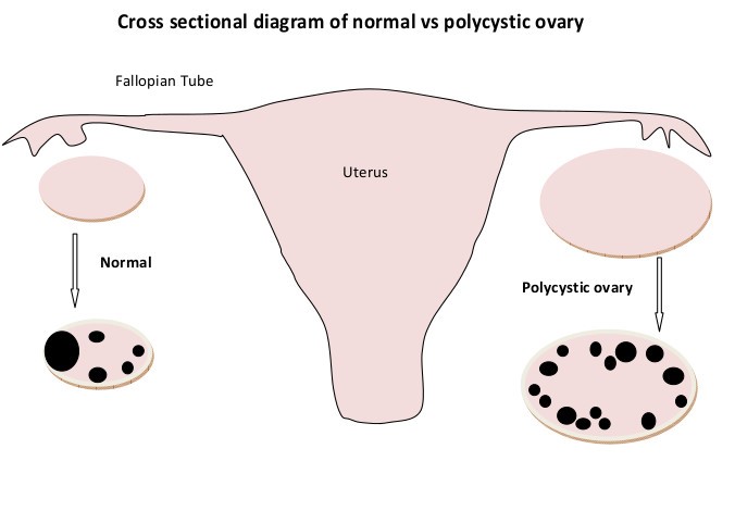 normal vs polycystic ovaries ultrasound