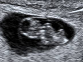 7 week transvaginal ultrasound